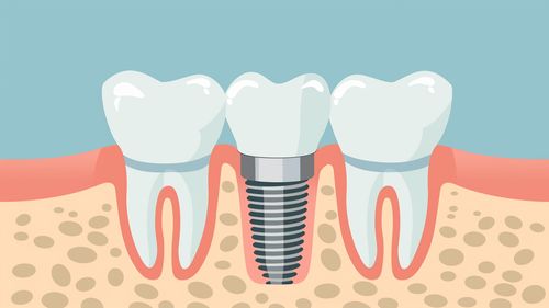 How To Get A Cheap Dental Implant