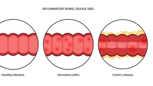 In-Depth Guide to Crohn's Disease: Symptoms and Treatment Approaches